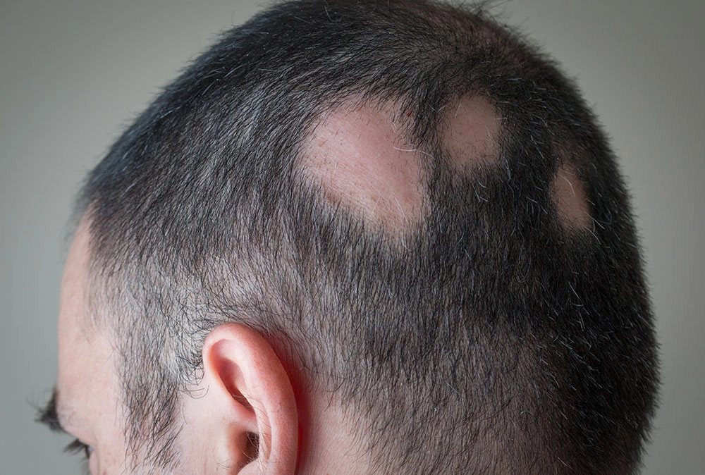 alopecija areata